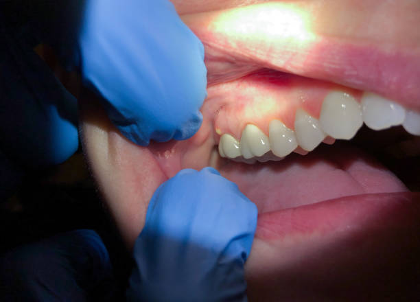 Best Emergency Treatment for Oral Infections in Welby, CO